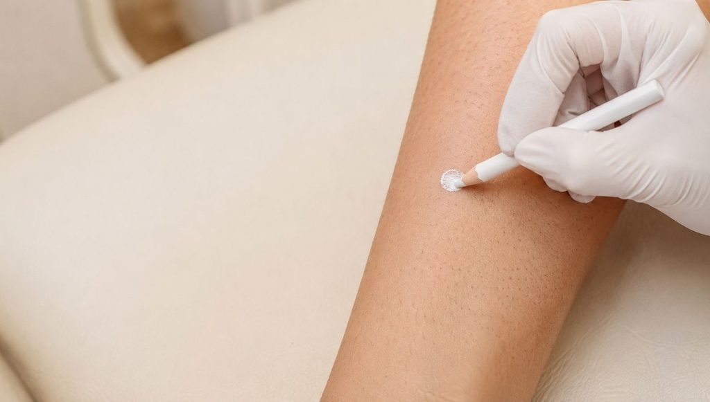 Zaštita mladeža belom olovkom pre laserske epilacije.